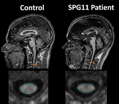 Neuroimaging in Hereditary Spastic Paraplegias: Current Use and Future Perspectives